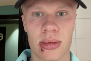 倒霉！哈蘭德社媒曬自拍：被公交車門撞了，縫了3針&看起來還挺好